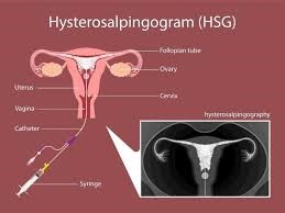 HSG (Hysterosalpingography) Test